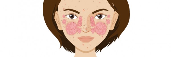 Lupus Vs Arthritis: What Are The Similarities And Differences?